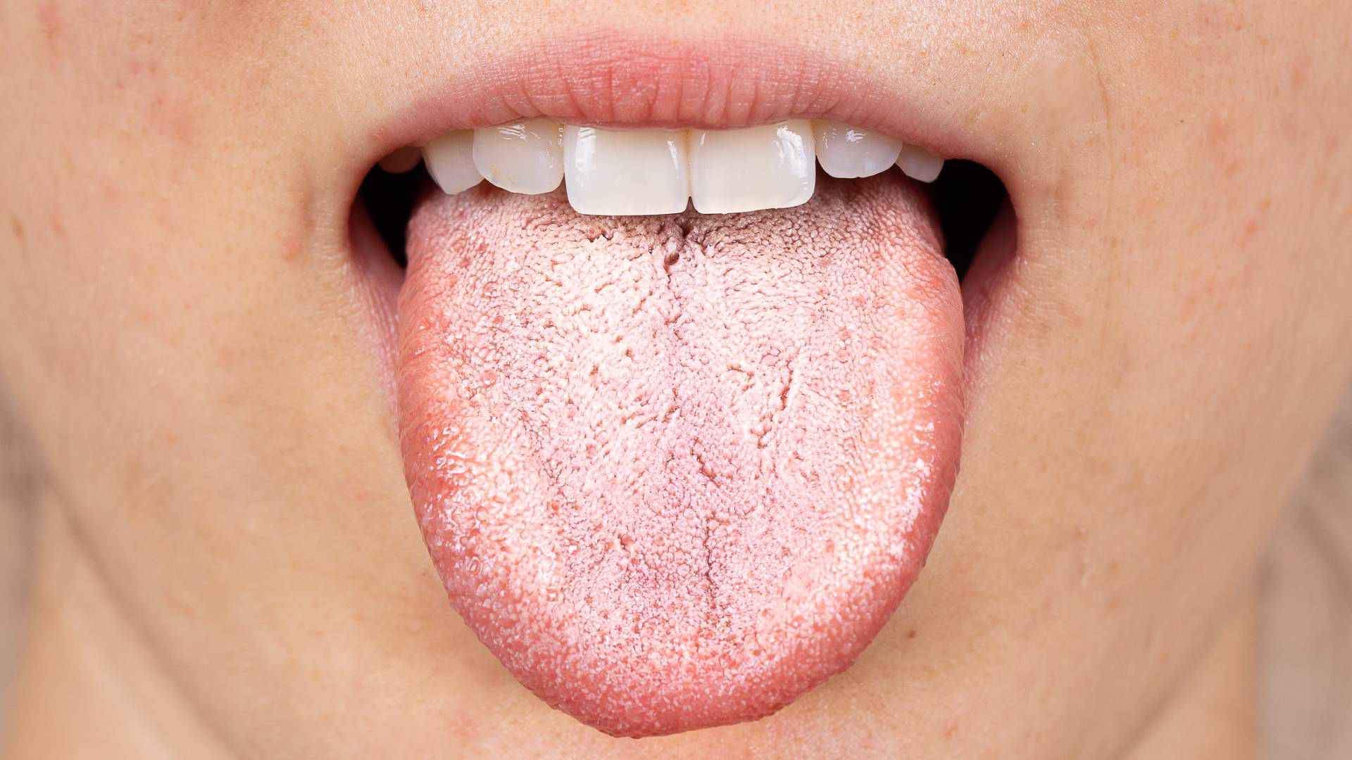 Vapers tongue